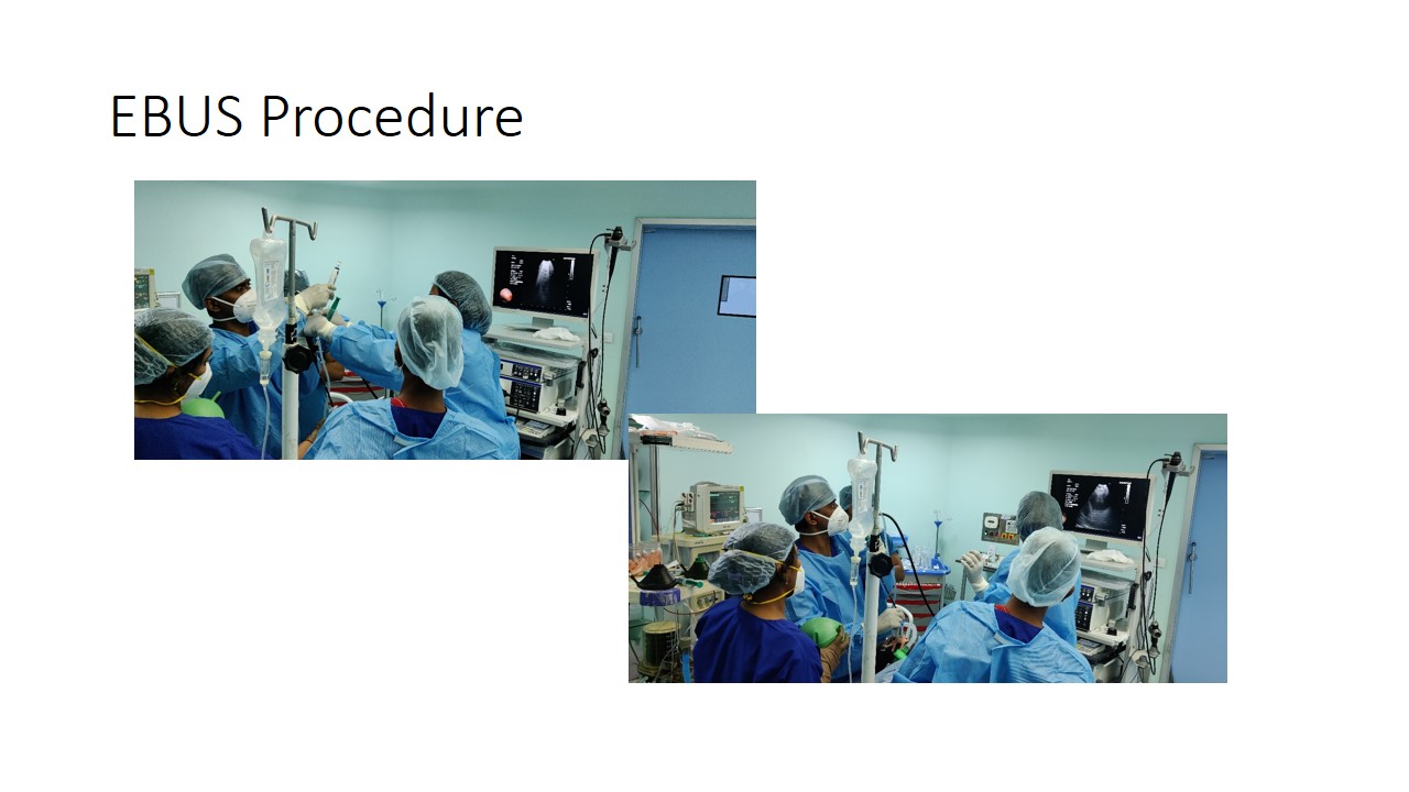 EBUS Procedure